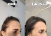 Nevo de Ota pode ser tratado com laser, explica biomédico