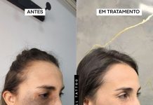 Nevo de Ota pode ser tratado com laser, explica biomédico