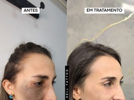 Nevo de Ota pode ser tratado com laser, explica biomédico