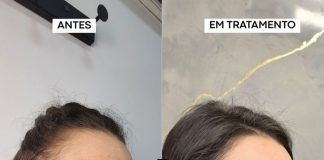 Nevo de Ota pode ser tratado com laser, explica biomédico