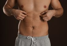 Definição em foco: a evolução da lipoaspiração masculina