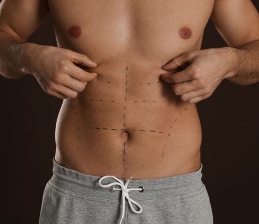 Definição em foco: a evolução da lipoaspiração masculina