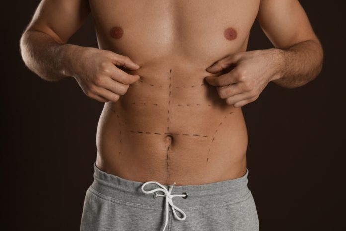 Definição em foco: a evolução da lipoaspiração masculina Definição em foco: a evolução da lipoaspiração masculina