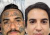 Remoção de tatuagem cresce e muda perfil de quem procura