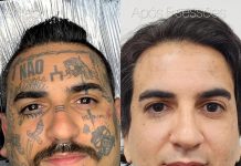 Remoção de tatuagem cresce e muda perfil de quem procura