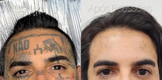 Remoção de tatuagem cresce e muda perfil de quem procura