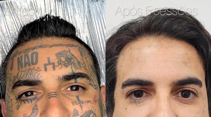 Remoção de tatuagem cresce e muda perfil de quem procura