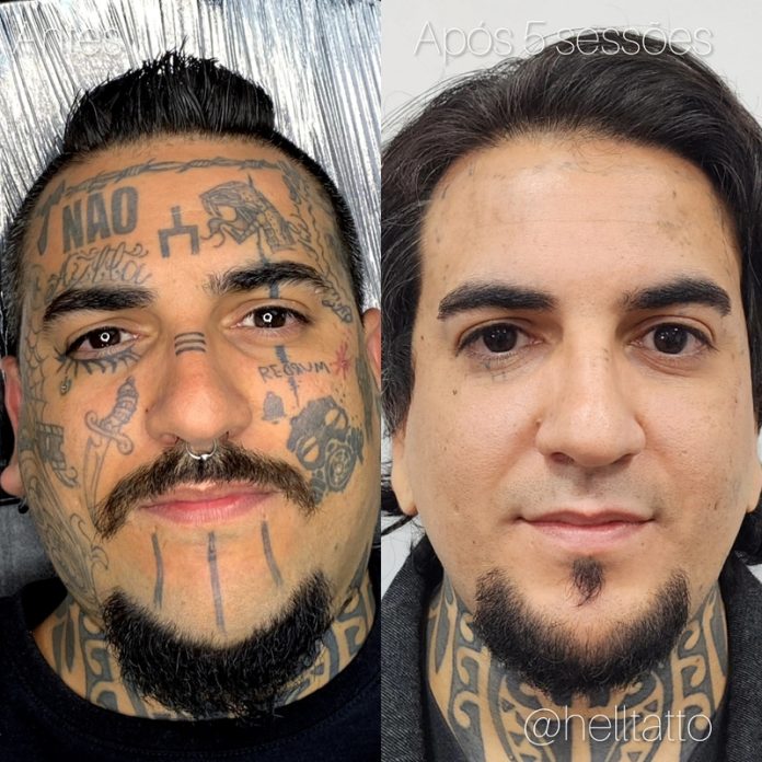 Remoção de tatuagem cresce e muda perfil de quem procura